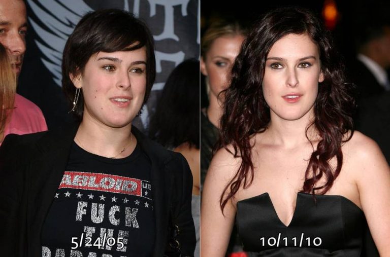 Searching for Perfection Rumer Willis Before and After Plastic Surgery In Geneve