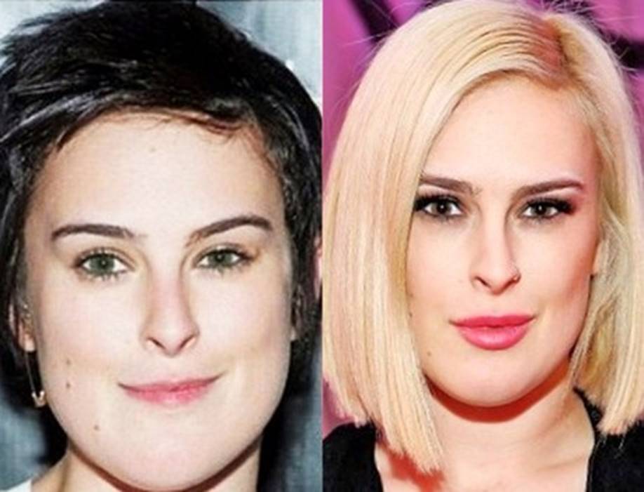 Rumer Willis Plastic Surgery Before And After